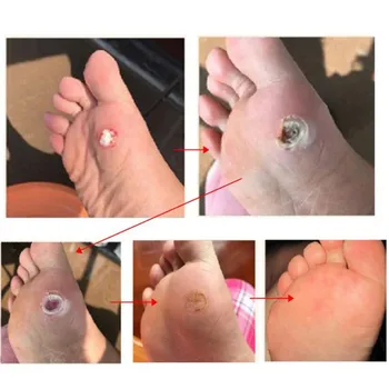 54PCS Picior de Porumb Criminal Calusuri Negii Plantari Ghimpele Durerii Ipsos Picior de Îngrijire Instrument Medical Autocolant Toe Protector de Îngrijire de Picioare